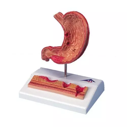 Model przekroju żołądka z wrzodami K17